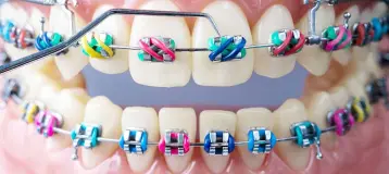 M&M Braces