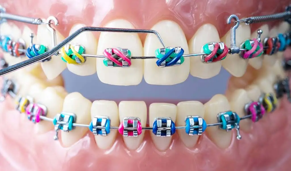 M&M Braces