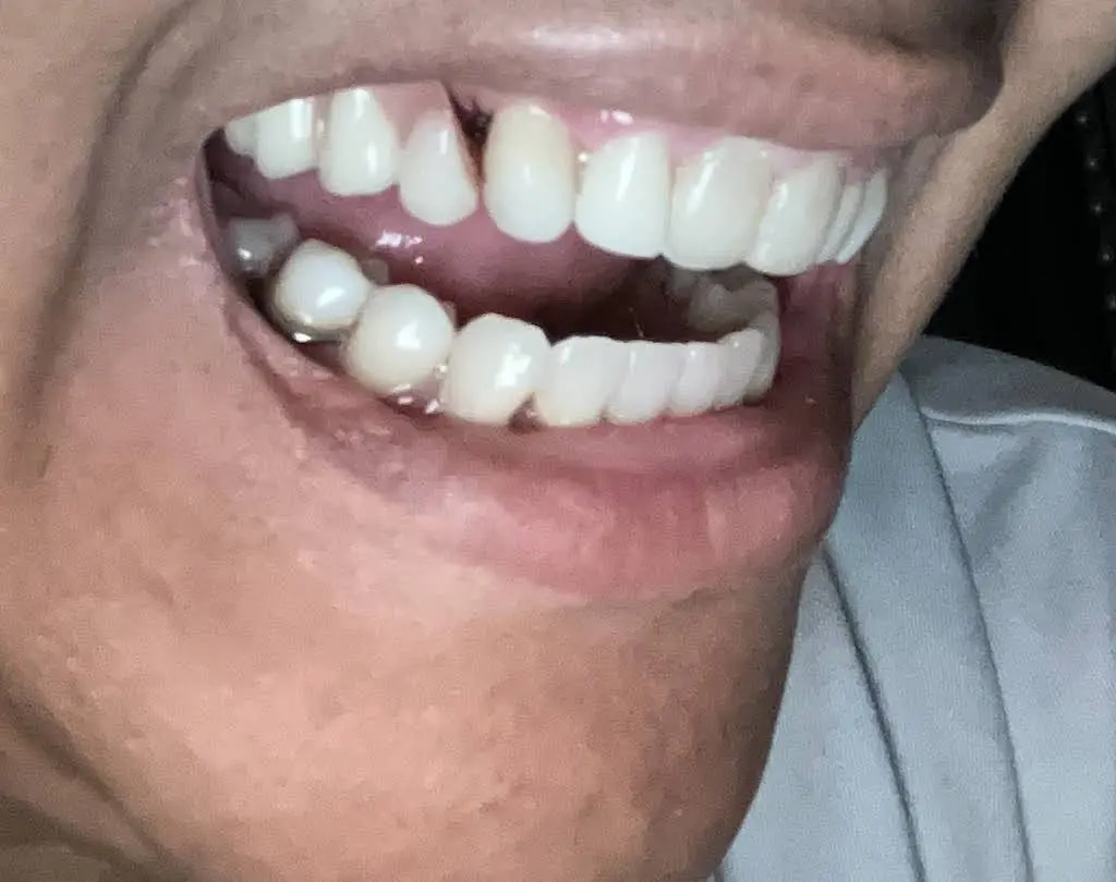 Affordable Dentures & Implants