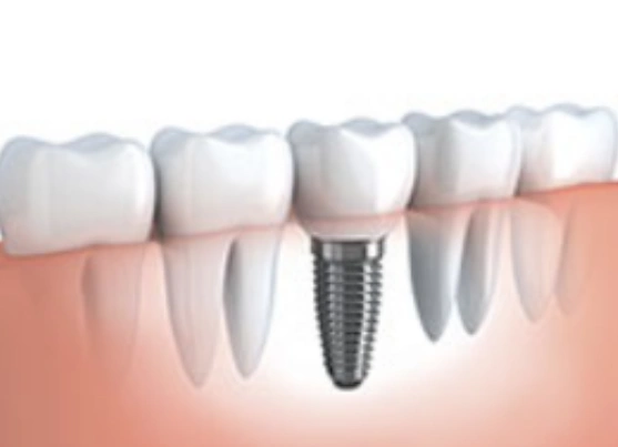 Dental, Dentures & Implants