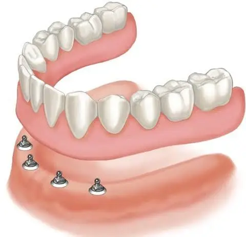 A PLUS DENTURES