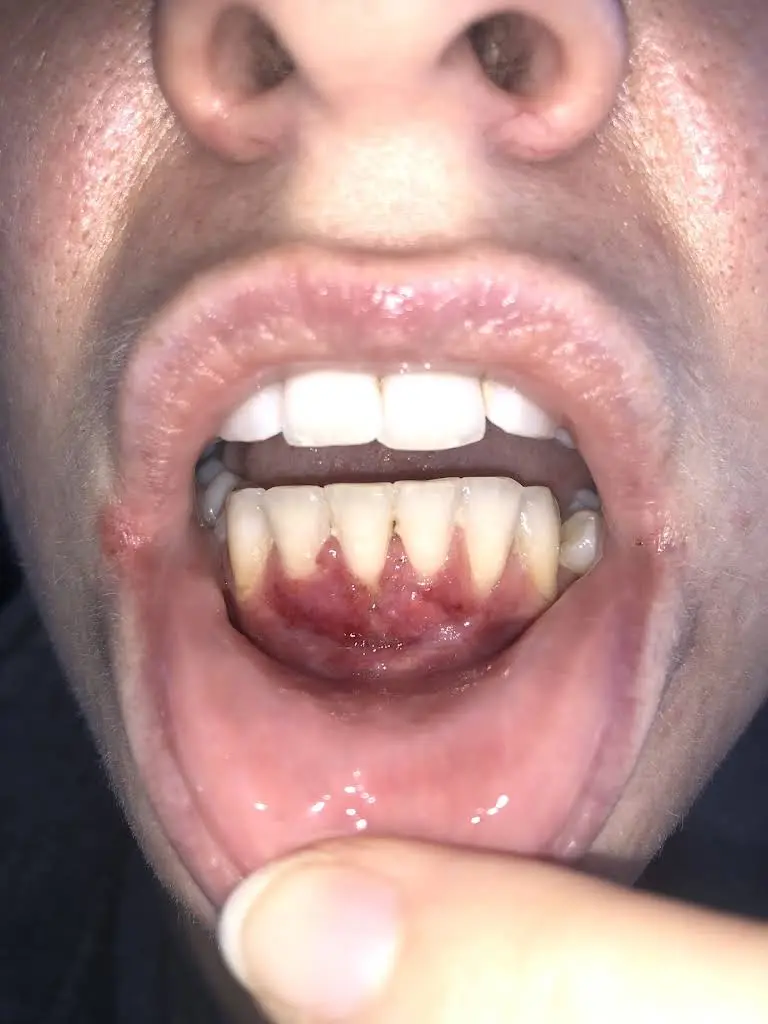 Tidewater Laser Perio and Implants