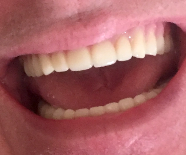 Advanced Prosthodontics