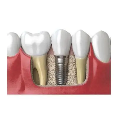 Advanced Prosthodontics