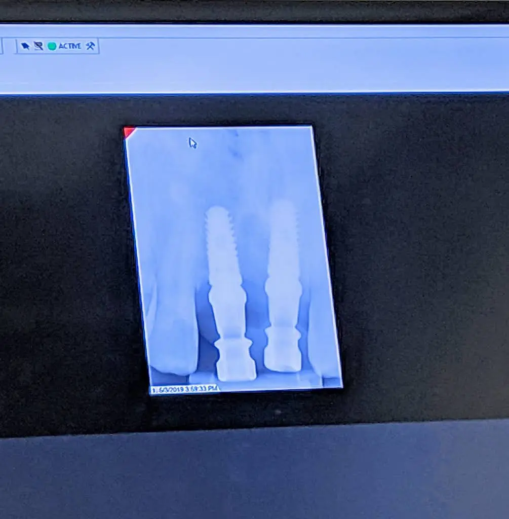 Smart Arches Dental Implants - Bartonsville