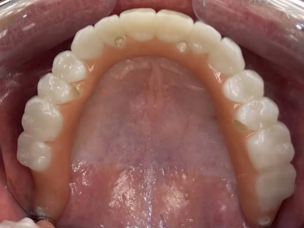Affordable Dentures & Implants
