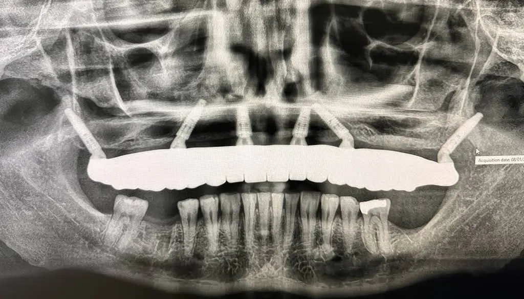 Affordable Dentures & Implants