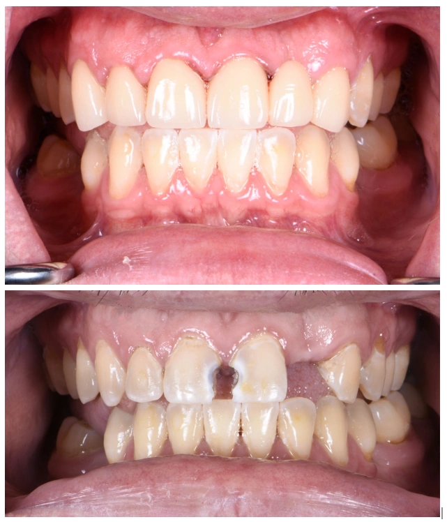All On Implants and Modern Dentistry