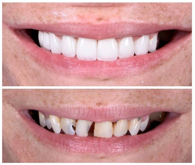 All On Implants and Modern Dentistry