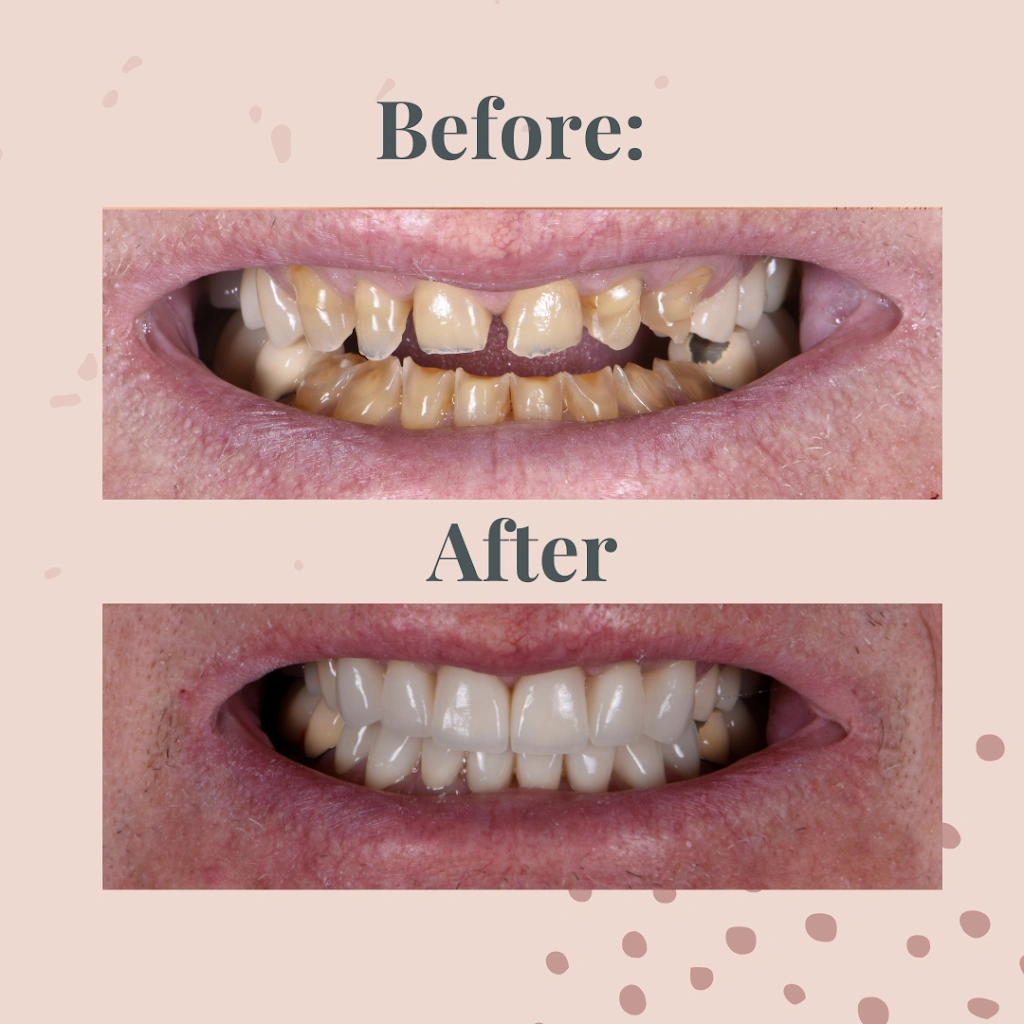 All On Implants and Modern Dentistry