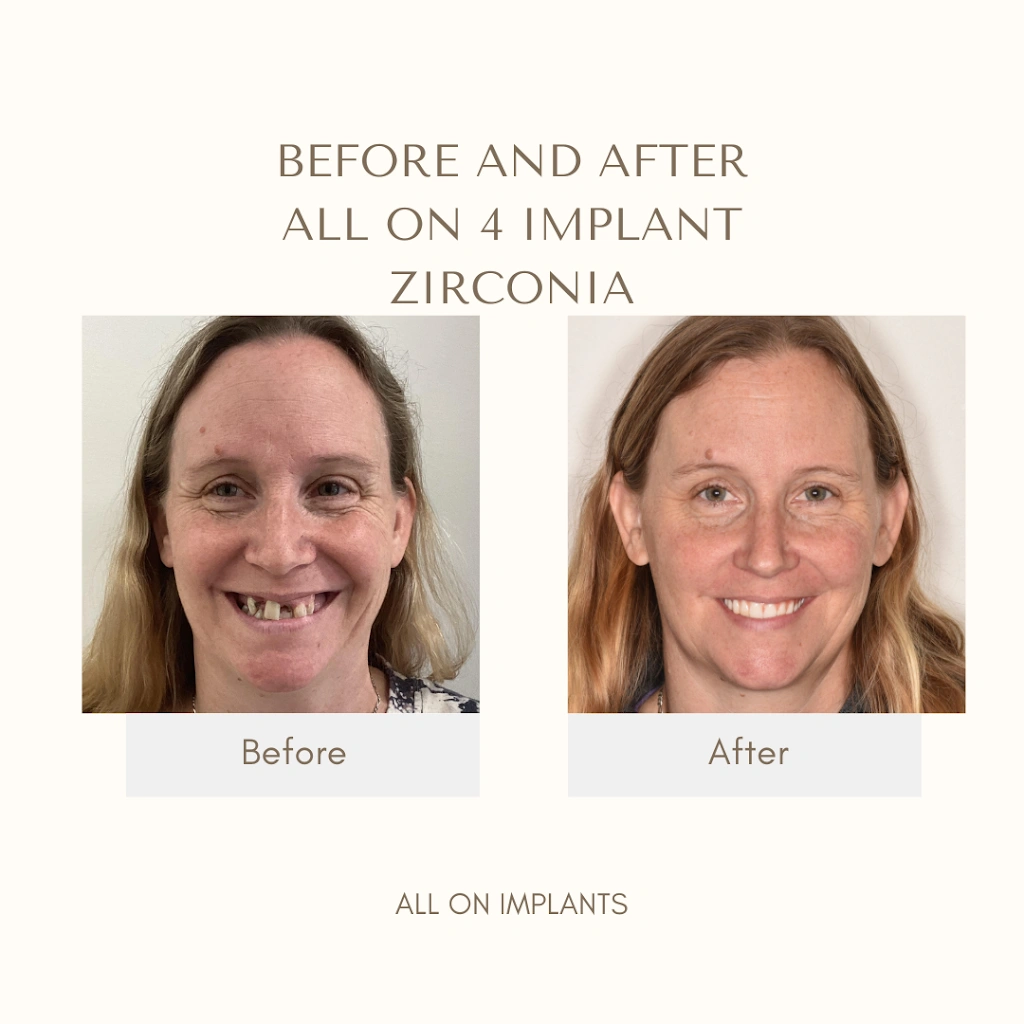 All On Implants and Modern Dentistry