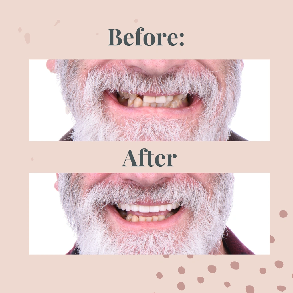 All On Implants and Modern Dentistry