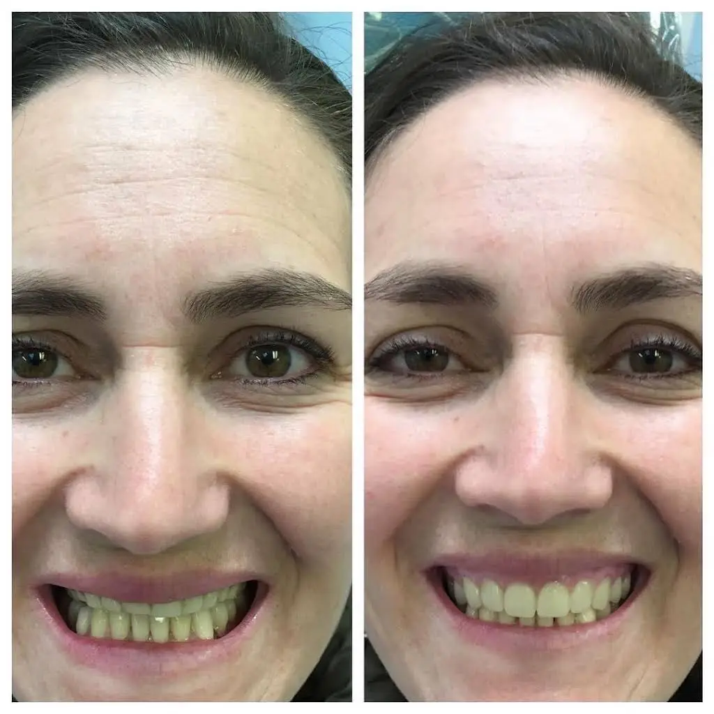 NÜVA Smile