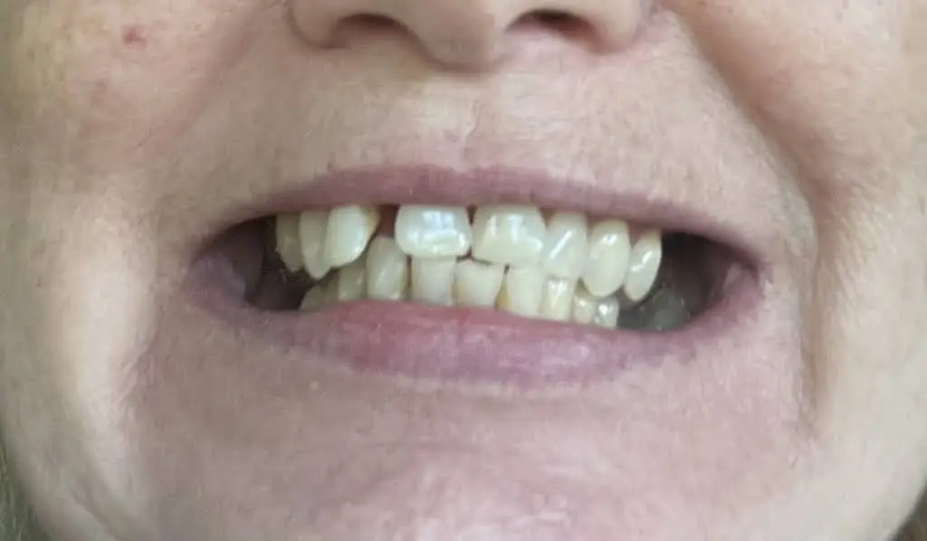 Affordable Dentures & Implants
