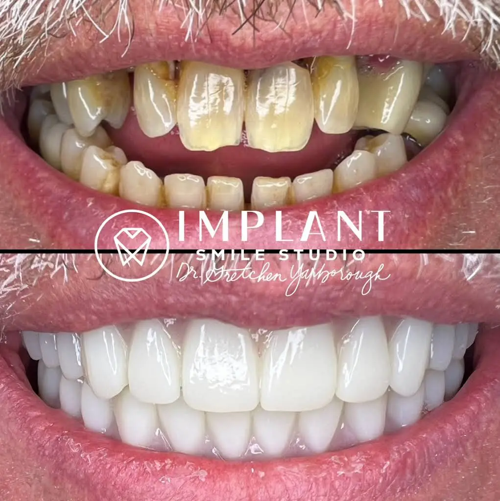 Implant Smile Studio