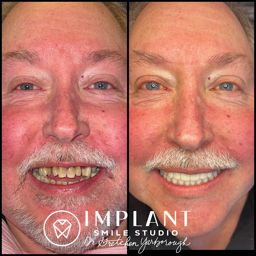 Implant Smile Studio