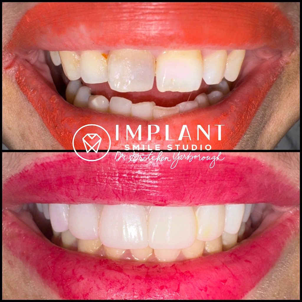 Implant Smile Studio