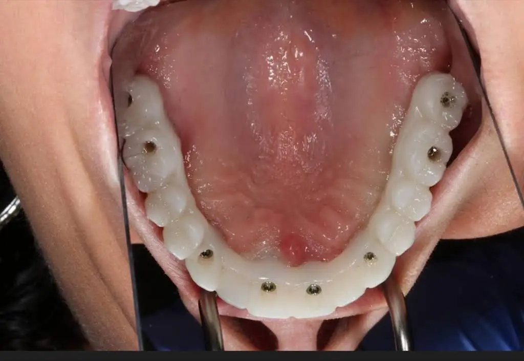 Roc Perio & Implants
