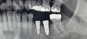 Affordable General Dentistry & Implants