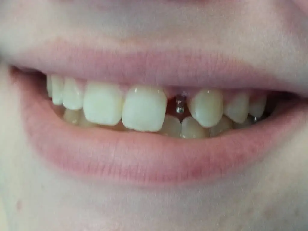 Affordable General Dentistry & Implants