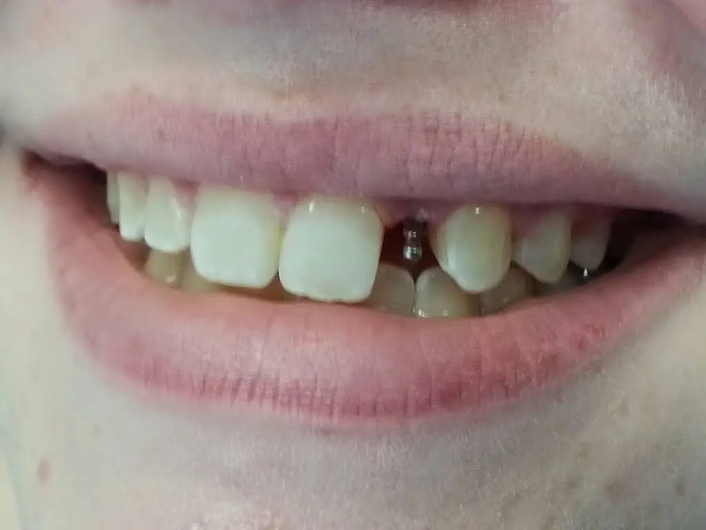 Affordable General Dentistry & Implants