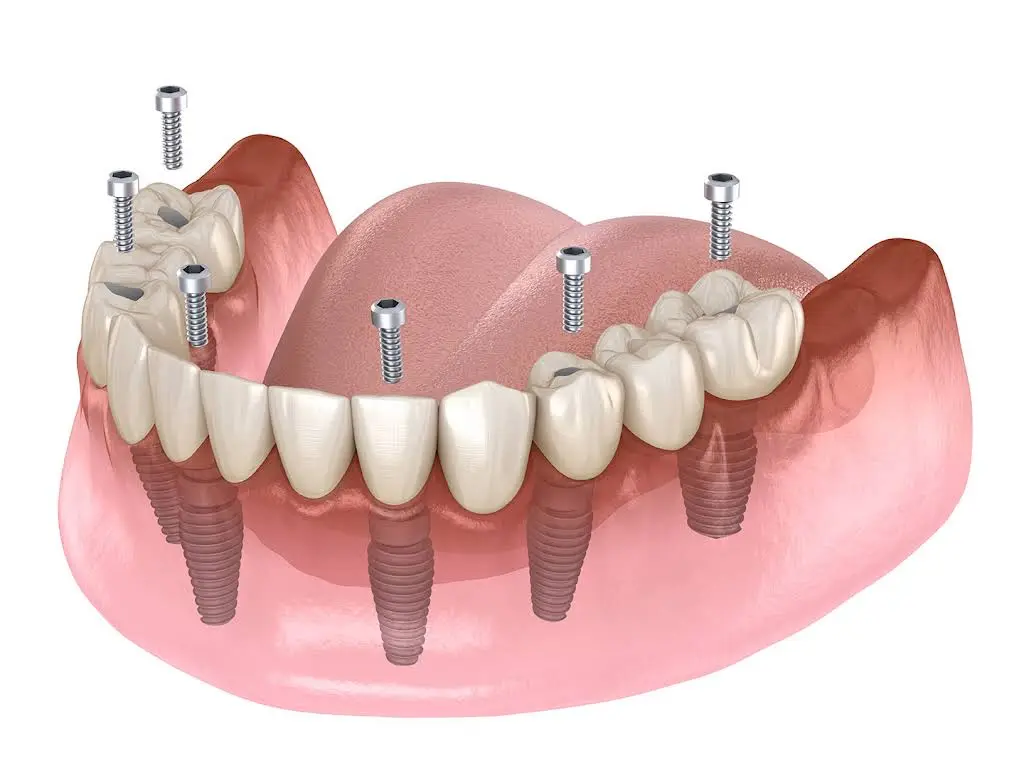 Willow Grove Affordable Dental Implants - Full Mouth Implants
