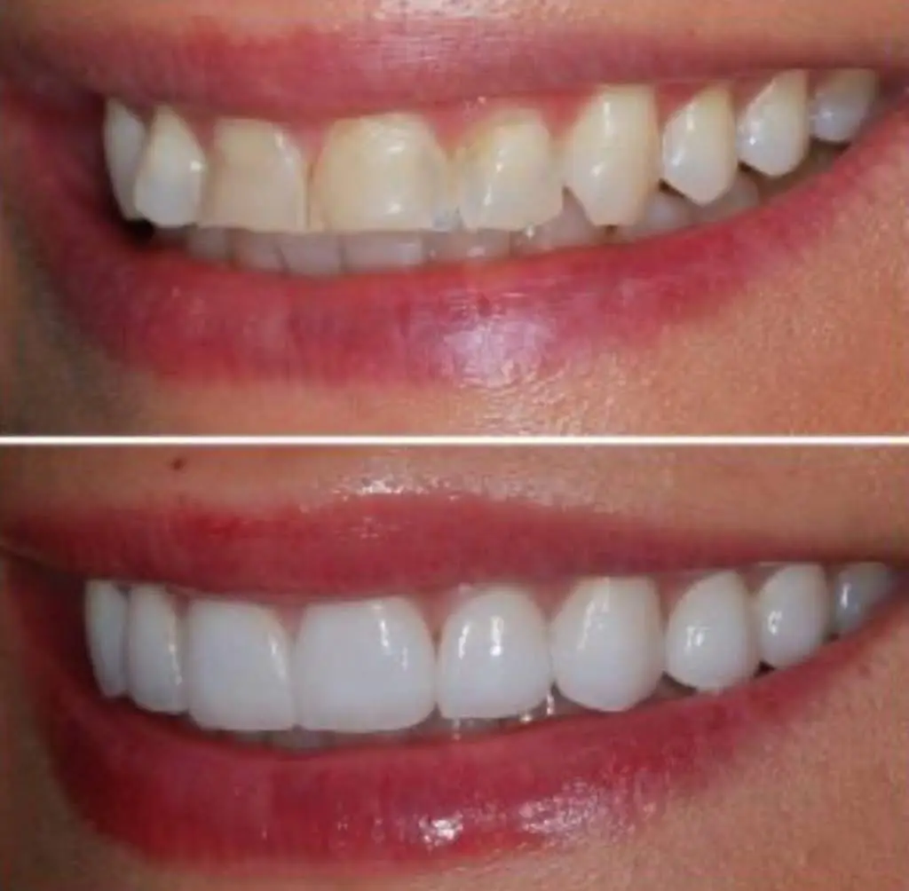 NÜVA Smile