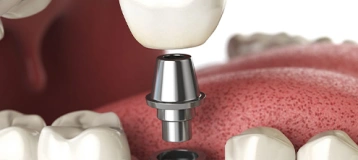 Dental Implants of Morris County
