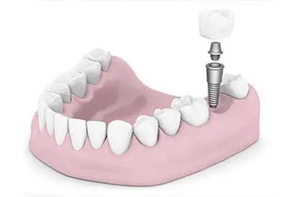 Dental Implants of Morris County