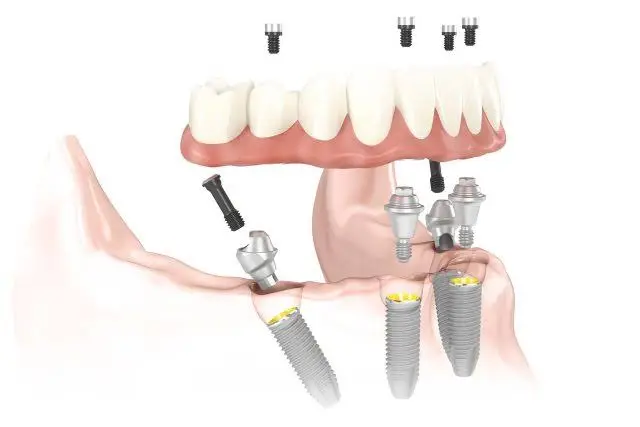 Dental Implants of Morris County