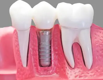 Optimum Oral Surgery & Dental Implants