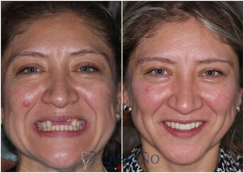 Castano Periodontics and Dental Implants