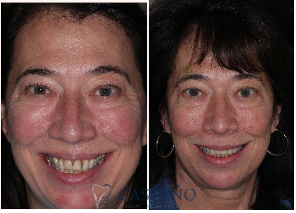 Castano Periodontics and Dental Implants