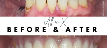 Precision Implant Care | Dr. Robert Mikhli
