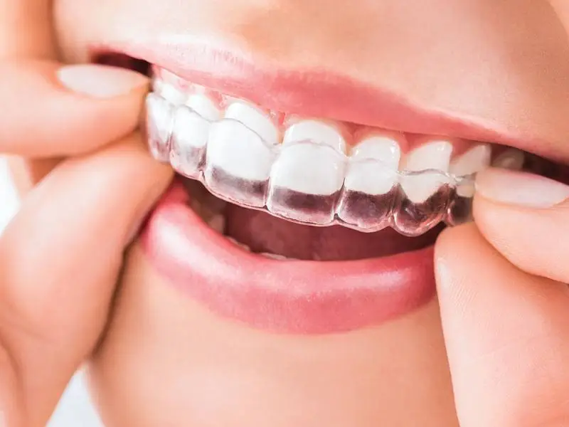 Menker Braces