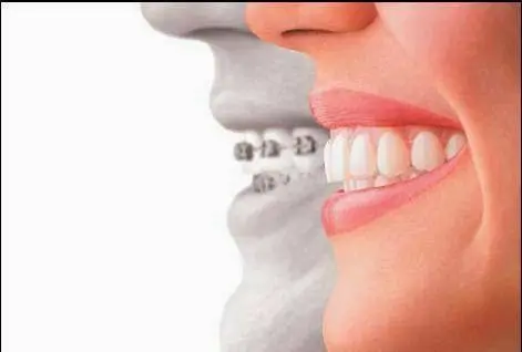 Menker Braces