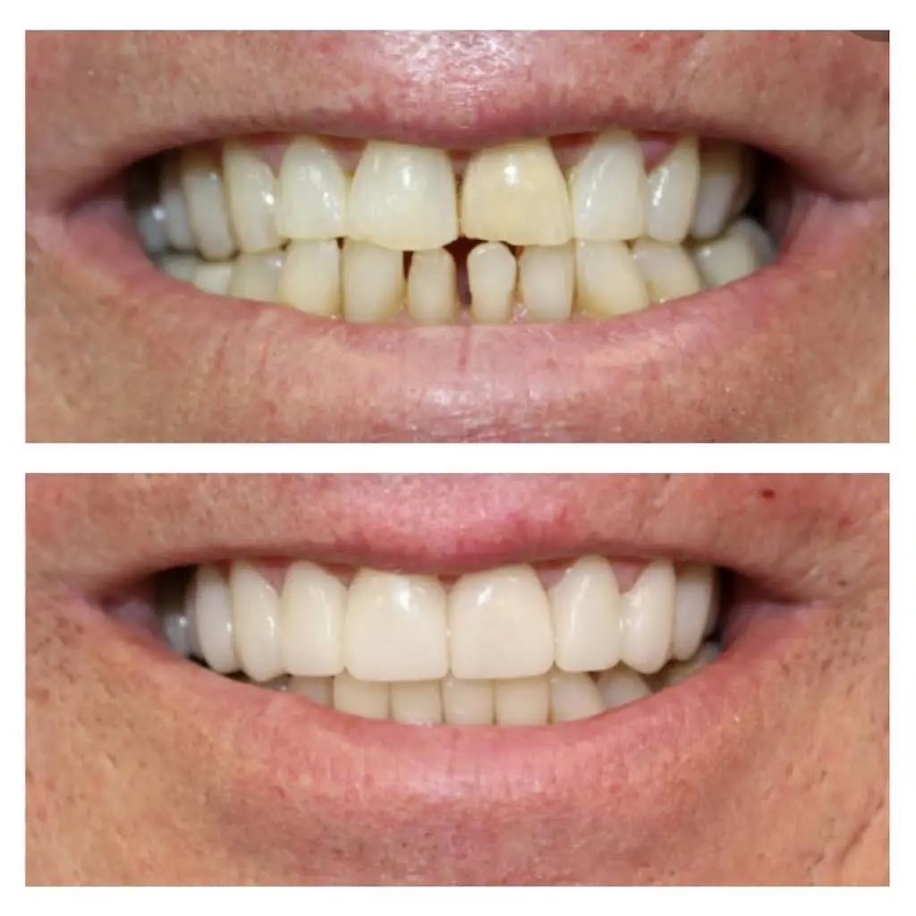 NÜVA Smile