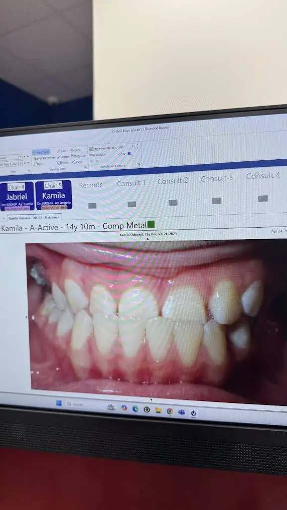 Diamond Braces