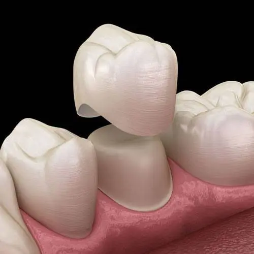 Dental Crowns Dentist Brooklyn
