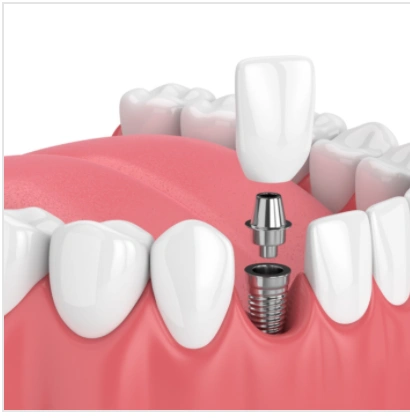 Brooklyn Smile & Dental Implants