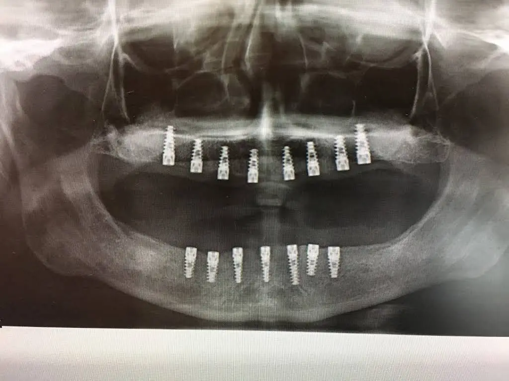 Malo Smile USA Elizabeth Dental Implants