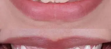 NÜVA Smile
