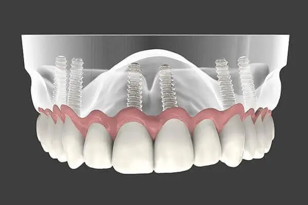 Periodontal & Implant Associates
