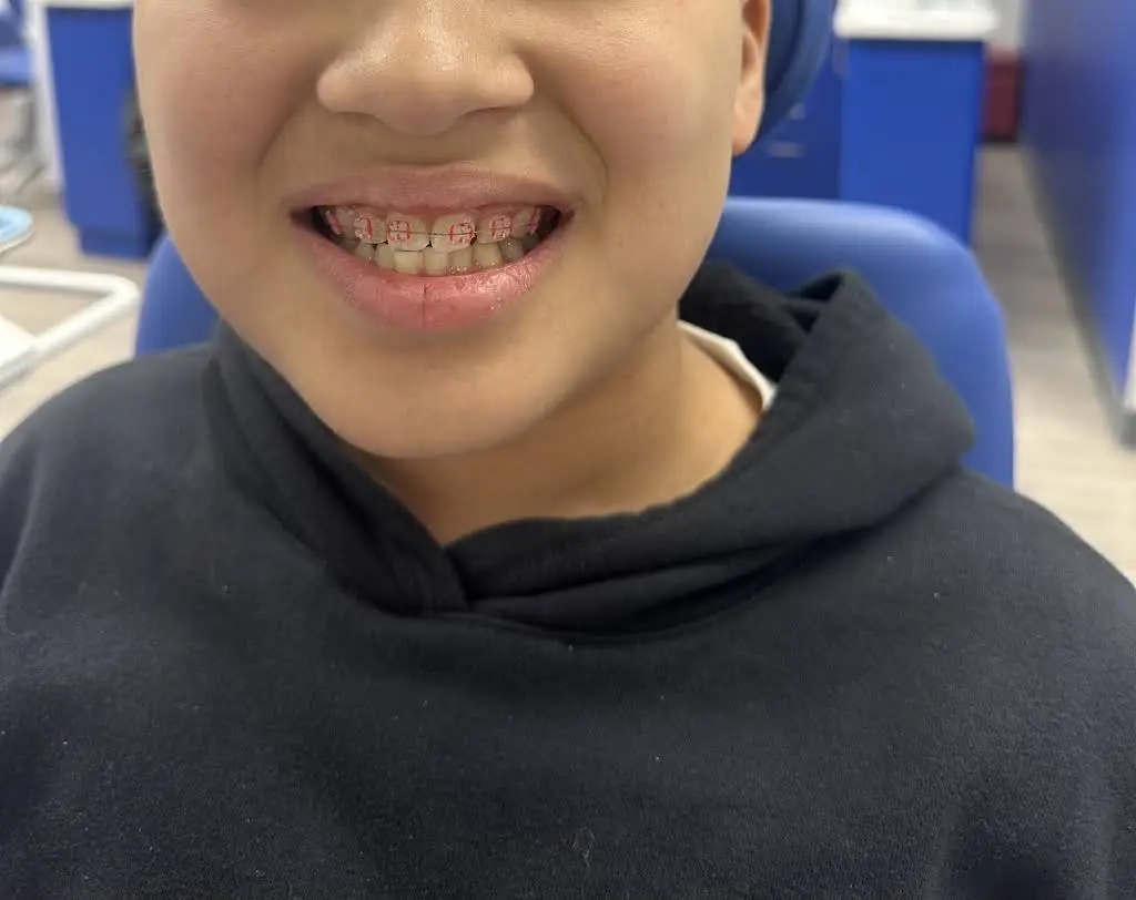 Diamond Braces