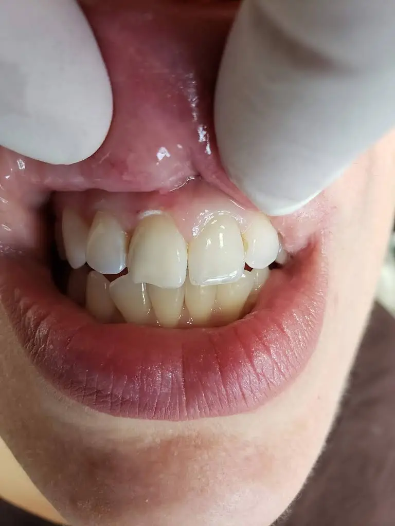 NJ Root Canal