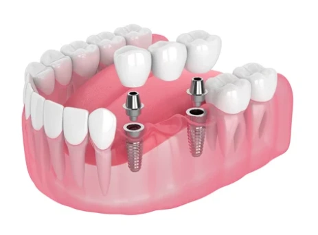 Harrison Implant and Family Dentistry