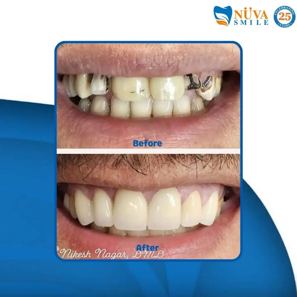 NÜVA Smile