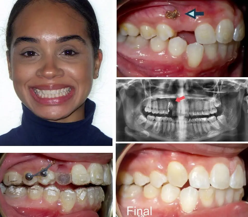 Diamond Braces