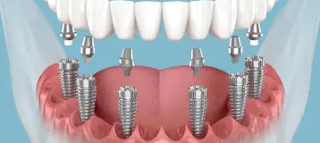 South Central Dental Implants