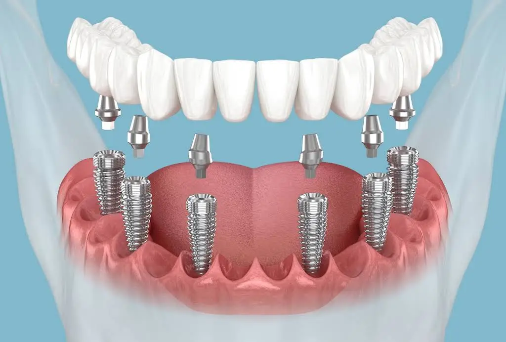 South Central Dental Implants - Professional dental clinic exterior with modern facilities